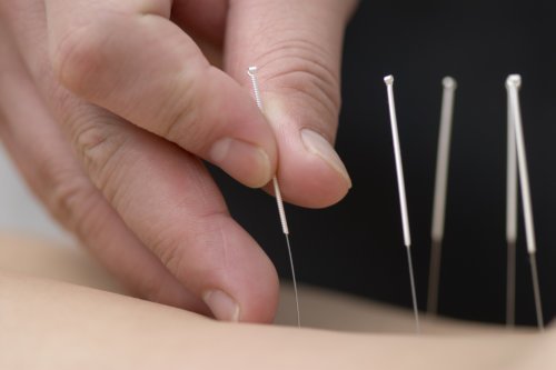 chineseMedicineAcupuncture